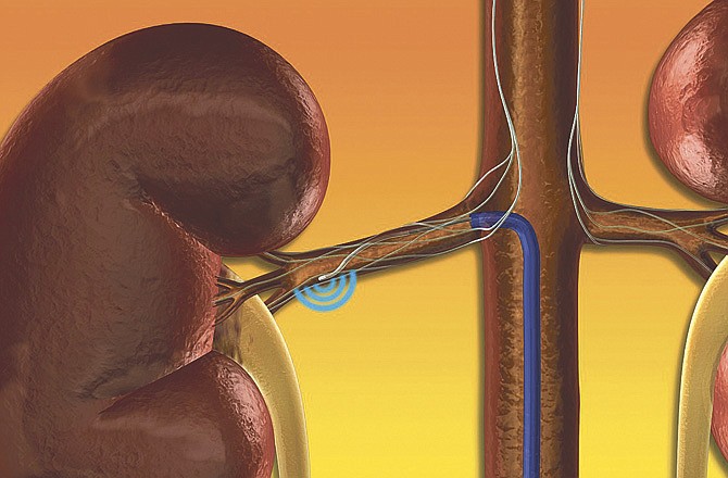 This illustration provided by Ardian's Symplicity Catheter System shows the Symplicity Catheter System, which delivers low-power RF energy to deactivate the renal sympathetic nerves. A study reported Nov. 17 at the American Heart Association conference in Chicago says that some people who couldn't get their blood pressure under control despite taking a fistful of pills every day found relief from an experimental treatment using radio waves to zap nerves near the kidneys that fuel high blood pressure.