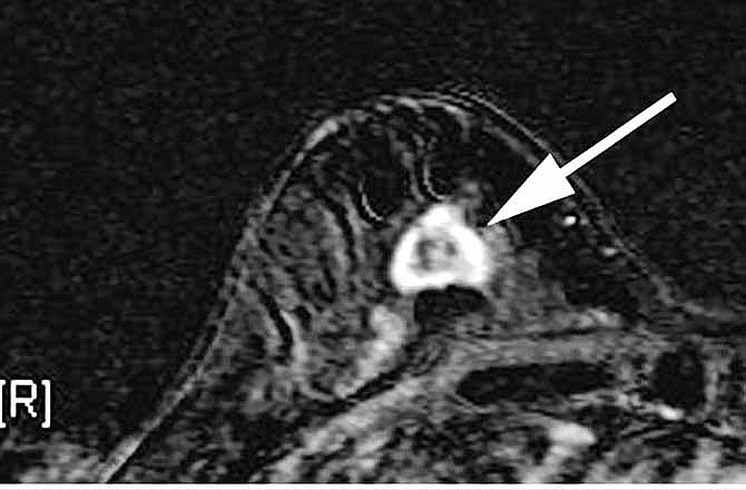 This undated image made available by the Duke University Department of Medicine in 2007 shows a right breast MRI from a 55-year-old woman with extreme breast density. The superimposed arrow points to a 2 cm rapidly enhancing lesion which was later confirmed by biopsy to be invasive breast cancer. Doctors say they have successfully dropped the first "smart bomb" on breast cancer, using a drug to deliver a toxic payload to tumor cells while leaving healthy ones alone. 