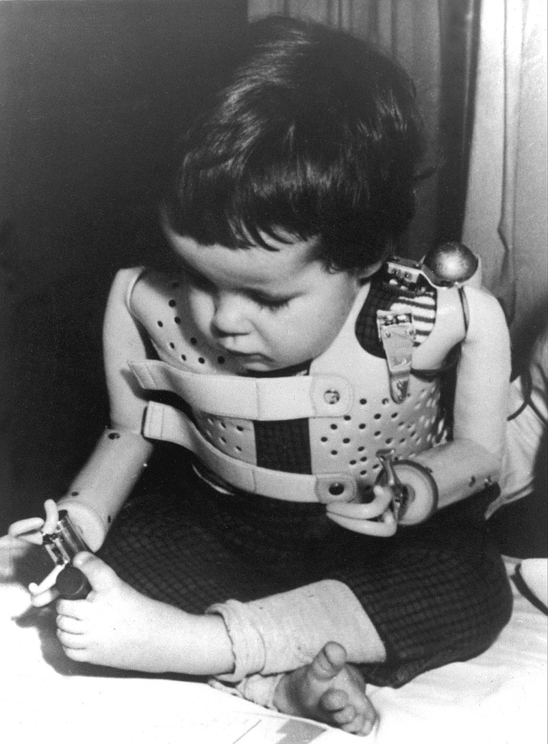 A three-year-old girl, born without arms to a mother who took the drug thalidomide, uses power-driven artificial arms in 1965. Pharmaceutical company Gruenenthal, German manufacturer of anti-morning sickness drug thalidomide, has for the first time apologized to people who were born with congenital birth defects as a result of its use.