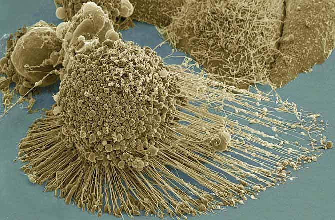 This undated scanning electron micrograph image made available by the National Institutes of Health and National Center for Microscopy in August 2013 shows HeLa cells. The cancerous cells, originally taken from Henrietta Lacks in 1951 without her knowledge or consent, were the first human cells that could be grown indefinitely in a laboratory. These "HeLa" cells have been crucial for key developments in such areas as vaccines and cancer treatments. 