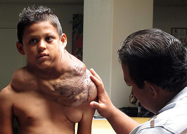In this 2012 file photo, a Ciudad Juarez-born boy suffering from a massive tumor has his shoulder examined. The 11-year-old Mexican boy had the growth removed Monday.