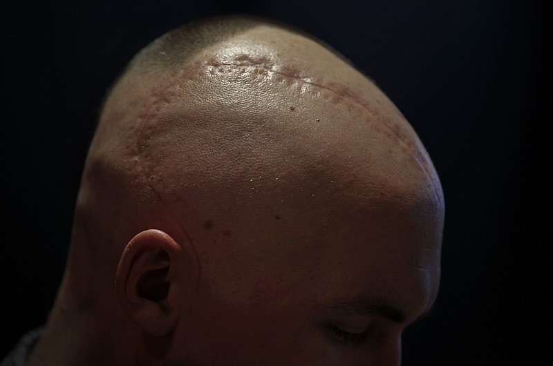 A scar from a brain surgery is seen on Chase Sims' head at Prestonwood Baptist Church in Plano, Texas, Wednesday, April 20, 2016.  Sims is batting a brain tumor while embracing each day. 