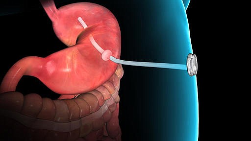 This rendering provided by Aspire Bariatrics, Inc. demonstrates the use of the AspireAssist weight loss device, approved by the Food and Drug Administration on Tuesday, June 14, 2016. The AspireAssist system consists of a thin tube implanted in the stomach, connecting to an outside port on the skin of the belly, which itself is connected to an external device, which helps remove nearly a third of the food stored in the stomach before calories are absorbed into the body, causing weight loss. (Aspire Bariatrics, Inc. via AP)