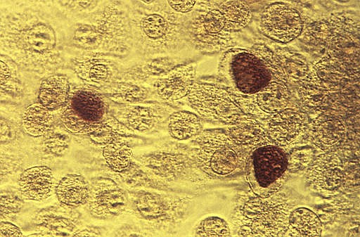 This 1975 microscope image made available by the the Centers for Disease Control and Prevention shows Chlamydia trachomatis bacteria magnified 200X. (Dr. E. Arum, Dr. N. Jacobs/CDC via AP)