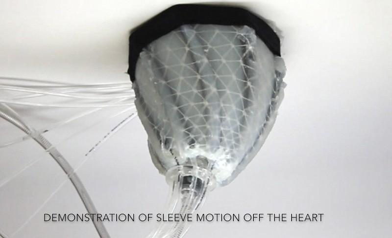 In this image from video, provided by Harvard University, a robotic sleeve designed to encase a diseased heart and gently squeeze it to help it better pump blood. Researchers at Harvard and Boston Children's Hospital developed the experimental device in hopes of improving treatment of heart failure, when the heart becomes too weak to pump. 
