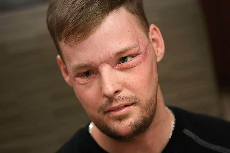 In this Jan. 24, 2017, photo, face transplant recipient Andy Sandness attends a speech therapy appointment at Mayo Clinic in Rochester, Minn. He wasn't allowed to see himself immediately after the surgery. His room mirror and cell phone were removed. When he finally did see his face after three weeks, he was overwhelmed. "Once you lose something that you've had forever, you know what it's like not to have it. ... And once you get a second chance to have it back, you never forget it." Just having a nose and mouth are blessings, Sandness says. "The looks are a bonus." 