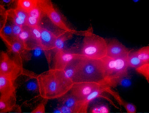 This undated fluorescence-colored microscope image made available by the National Institutes of Health in September 2016 shows a culture of human breast cancer cells. Environmental risks and heredity get the most blame for cancer, but new research released on Thursday, March 23, 2017 suggests random chance may play a bigger role than people realize: Healthy cells naturally make mistakes when they multiply, typos in your DNA that can leave new cells carrying cancer-prone genetic mutations. 