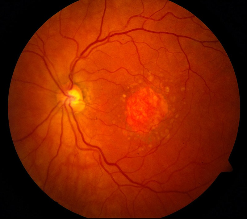 This image provided by the National Eye Institute shows a microscopic image of a retina being damaged by the so-called "dry" form of age-related macular degeneration. An experimental drug is showing promise against an eye disease that blinds older adults. Age-related macular degeneration gradually erodes seniors' central vision, making it difficult to read or see faces. 