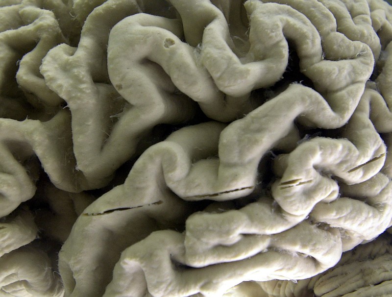 <p>AP</p><p>A section of a human brain with Alzheimer’s disease is on display at the Museum of Neuroanatomy at the University at Buffalo in New York.</p>