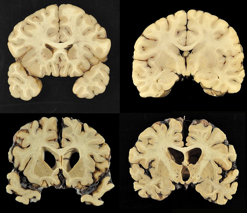 This combination of photos provided by Boston University shows sections from a normal brain, top, and from the brain of former University of Texas football player Greg Ploetz, bottom, in stage IV of chronic traumatic encephalopathy. According to a report released on Tuesday by the Journal of the American Medical Association, research on 202 former football players found evidence of a brain disease linked to repeated head blows in nearly all of them, from athletes in the National Football League, college and even high school. 