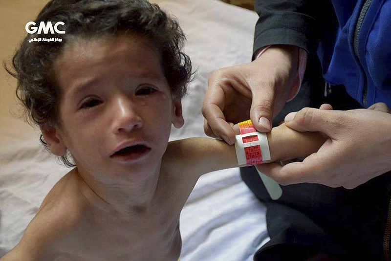 This photo provided on Sunday, Nov. 12, 2017 by the Syrian anti-government activist group Ghouta Media Center, which has been authenticated based on its contents and other AP reporting, shows a medical worker measuring a malnourished child's forearm in Ghouta, near Damascus, Syria. The United Nations Children agency says the worst malnutrition rate since the start of the Syria conflict nearly seven years ago has been recorded in a rebel-held suburb of Damascus, besieged since mid-2013. (Ghouta Media Center via AP)