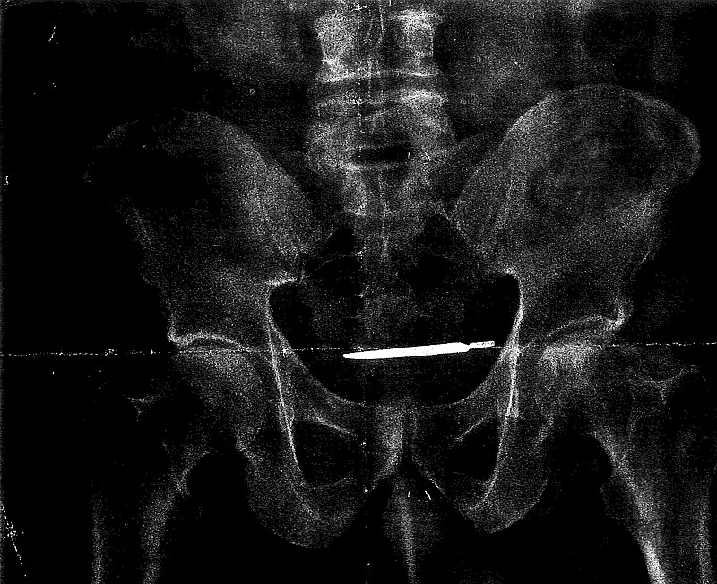 This X-ray image provided by the attorney for Glenford Turner, of Bridgeport, Ct., shows a scalpel that Turner claims was left inside him after undergoing surgery in 2013 at a Veterans Administration hospital in Connecticut. The army veteran is suing the hospital after the scalpel was only discovered years later and he suffered from long-term abdominal pain. (Courtesy of FAXON Law Group via AP)