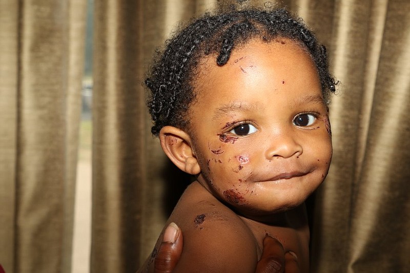 In this submitted photo taken of the baby, numerous bite marks, cuts and swelling are shown around the child's face, eyes, ears, scalp and shoulder. The complaint, filed by Texarkana lawyer Matt Keil, alleges the baby will be left with permanent scars.