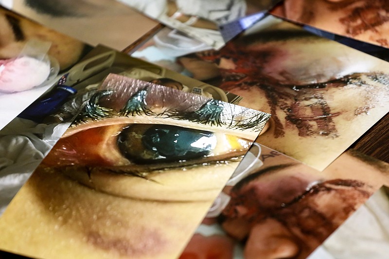 Photos of DaQuan Huey's eye injury lay on a table for the media to see after Huey spoke for the first about the incident that left blind in his left eye at the Texarkana District Attorney's Office in Texarkana, Texas on Tuesday, February 12, 2019. Huey was shot, allegedly, at close range by a Texarkana Texas police officer's JPX gun when trying to break up a fight on January 27, 2019. The damage from the impact of the shot severely damaged his left eye and according to doctors, has permanently lost vision.