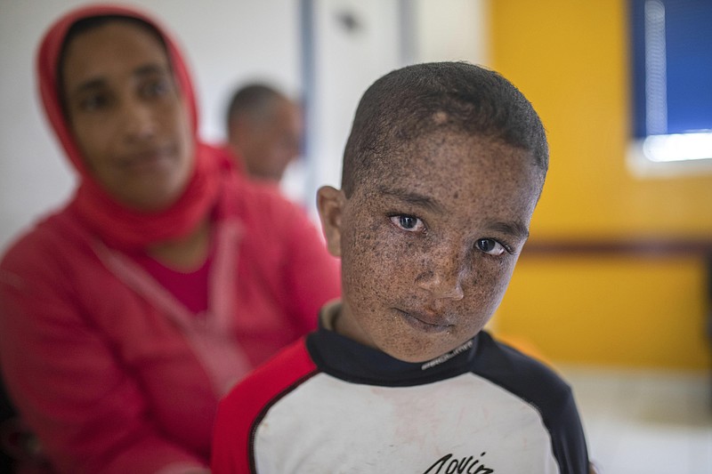 In this Wednesday, July 24, 2019 photo, Mohammad, 6, who is affected by a rare disorder called xeroderma pigmentosum, or XP, waits with his mother inside a hospital in Casablanca, Morocco. The rare genetic disorder can make the suns rays and other sources of ultraviolet light extremely damaging to the skin and eyes _ and is more common in North Africa than much of the world. (AP Photo/Mosa'ab Elshamy)