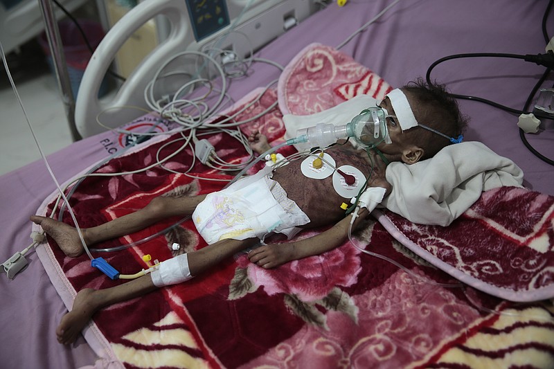 A malnourished girl Rahmah Watheeq receives treatment at a feeding center at Al-Sabeen hospital in Sanaa, Yemen, Tuesday. Nov. 3, 2020. Two-thirds of Yemen's population of about 28 million people are hungry, and nearly 1.5 million families currently rely entirely on food aid to survive, with another million people are set to fall into crisis levels of hunger before the year end, according to aid agencies working in Yemen. (AP Photo/Hani Mohammed)