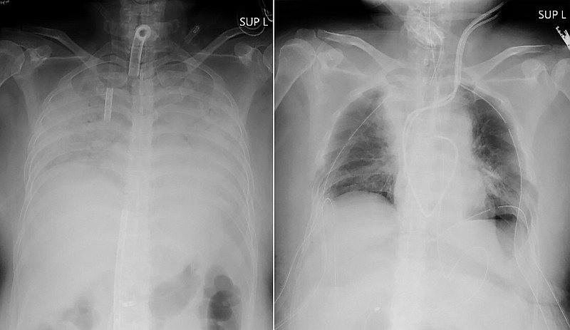 This combination of radiographs provided on April 9, 2021, by Kyoto University Hospital, shows the chest of a patient before the surgery, left, and after the surgery, right.  Doctors in Kyoto University Hospital announced Thursday, April 8, 2021, they have successfully performed the world's first transplant of lung tissue from living donors to a patient with severe lung damage from COVID-19. (Kyoto University Hospital via AP)