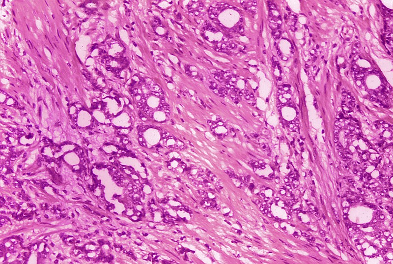 This 1974 microscope image made available by the Centers for Disease Control and Prevention shows changes in cells indicative of adenocarcinoma of the prostate. In results released Thursday, June 3, 2021 by the American Society of Clinical Oncology, doctors are reporting improved survival in men with advanced prostate cancer from an experimental drug that delivers radiation directly to tumor cells. (Dr. Edwin P. Ewing, Jr./CDC via AP)