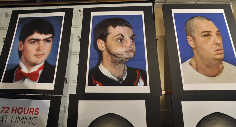 A series of photographs of Richard Lee Norris, the recipient of the most extensive full face transplant completed to date, are exhibited during a news conference Tuesday, March 27, 2012, at the University of Maryland Medical Center in Baltimore.