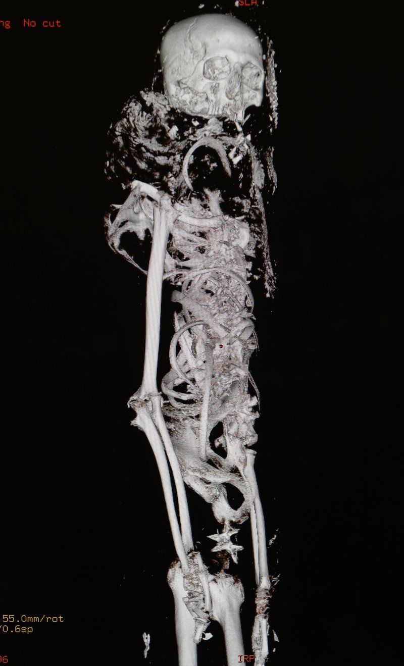 In this Friday, Feb. 1, 2013 photo, a three-dimensional image of a CT scan from a 4,000-year-old Egyptian mummy called Tjeby, from the Virginia Museum of Fine Arts, is shown at the HCA Virginia Imaging center in Richmond, Va. Experts hope the scan will help piece together more information about the mummy itself, as well as a better understanding into the early history of the mummification process.