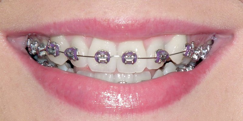 File photo Mandi Turner-Reed got her braces on in February of 2013.