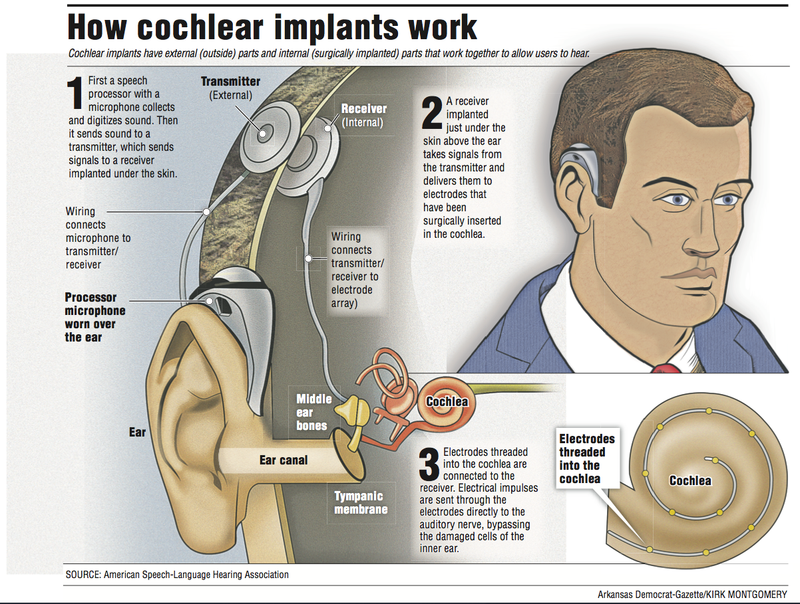 This graphic shows how cochlear implants work.