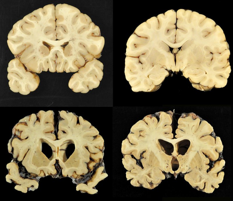 This combination of photos provided by Boston University shows sections from a normal brain, top, and from the brain of former University of Texas football player Greg Ploetz, bottom, in stage IV of chronic traumatic encephalopathy. 