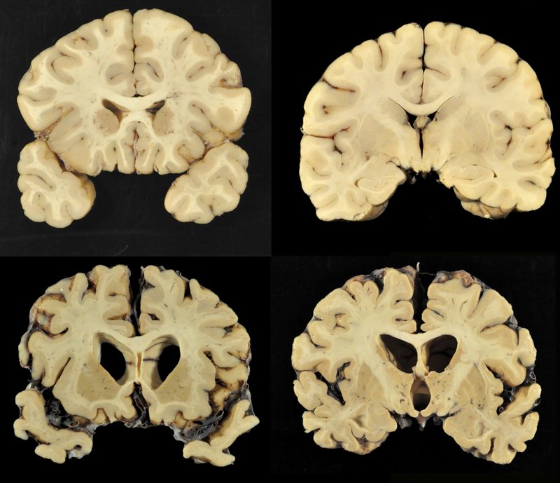 This combination of photos provided by Boston University shows sections from a normal brain, top, and from the brain of former University of Texas football player Greg Ploetz, bottom, in stage IV of chronic traumatic encephalopathy. According to a report released on Tuesday, July 25, 2017 by the Journal of the American Medical Association, research on the brains of 202 former football players has confirmed what many feared in life _ evidence of chronic traumatic encephalopathy, or CTE, a devastating disease in nearly all the samples, from athletes in the NFL, college and even high school. (Dr. Ann McKee/BU via AP)