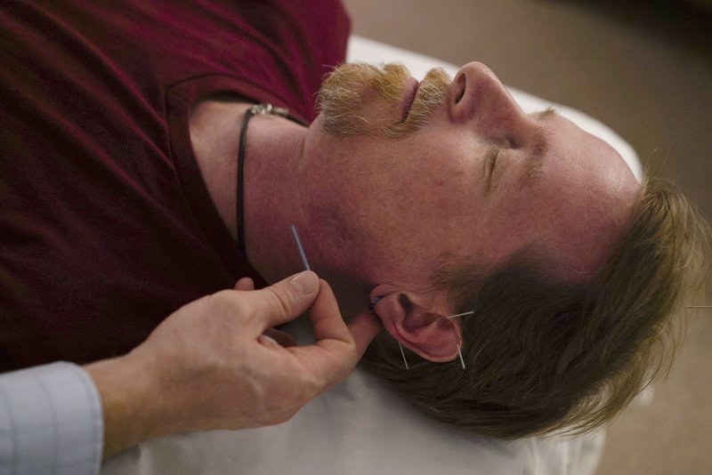 The Associated Press ACUPUNCTURE TREATMENT: David Ramsey, a Medicaid patient who suffers from chronic pain after falling off a cliff in 2011, receives acupuncture treatment in Warrensville Heights, Ohio on November 13, 2017. Long derided as pseudoscience, acupuncture is increasingly being used by doctors and officials seeking a new weapon in the nation's struggle with opioids. Ohio's Medicaid program is the latest to start covering the cost of acupuncture for low-income patients in pain, following similar programs in California, Massachusetts, Oregon, and Rhode Island.