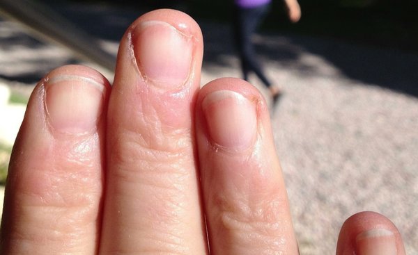 fingernail-time-lapse-4-month-recovery-youtube