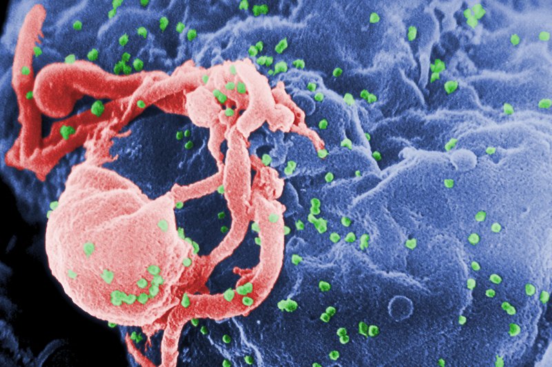 The Associated Press HIV: This undated photo provided by the Centers for Disease Control and Prevention shows a scanning electron micrograph of multiple round bumps of the HIV-1 virus on a cell surface. When newborns are infected with HIV, a new study suggests starting treatment right away is better than waiting just a few weeks to months. Harvard researchers found the earliest-treated babies had a much smaller "reservoir" of HIV still lurking in their bodies, and a better functioning immune system. story.lead_photo.caption