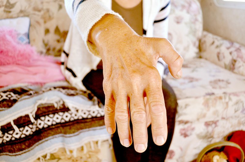RACHEL DICKERSON/MCDONALD COUNTY PRESS Libby Bond displays her hand on Oct. 7, 2019. Her hand appears typical of a patient with CMT. At one time she thought she had arthritis, but then it turned out to be a degenerative nerve disease.