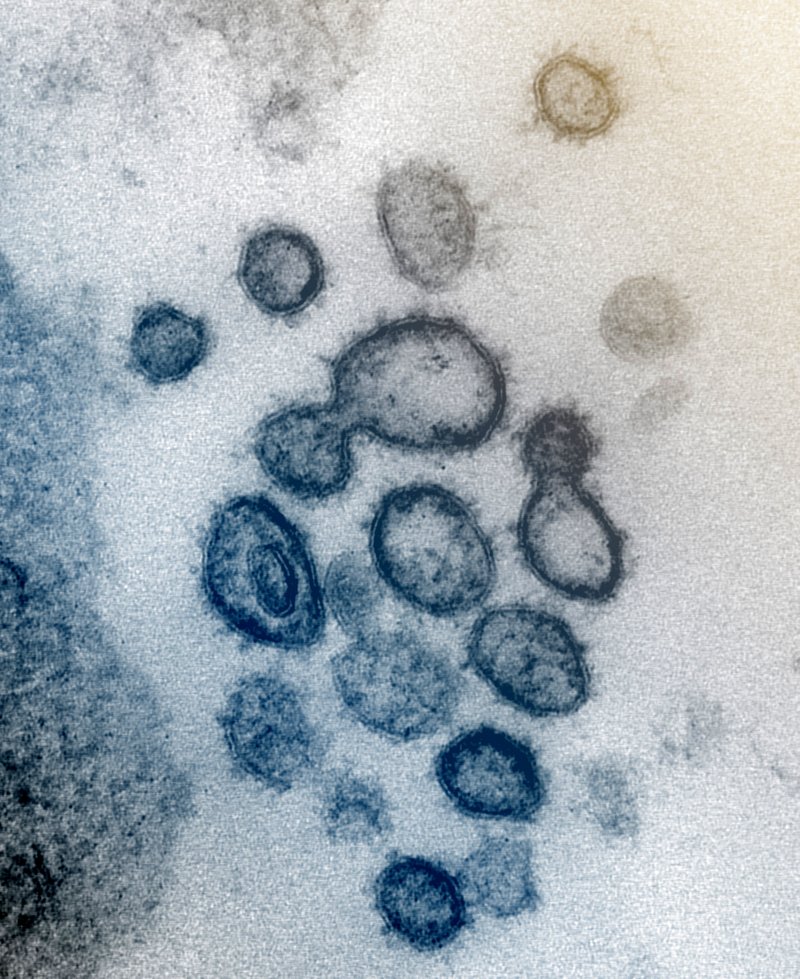 This undated electron microscope image made available by the U.S. National Institutes of Health in February 2020 shows the Novel Coronavirus SARS-CoV-2. Also known as 2019-nCoV, the virus causes COVID-19. The sample was isolated from a patient in the U.S. Dozens of research groups around the world are racing to create a vaccine as COVID-19 cases continue to grow. - NIAID-RML via AP