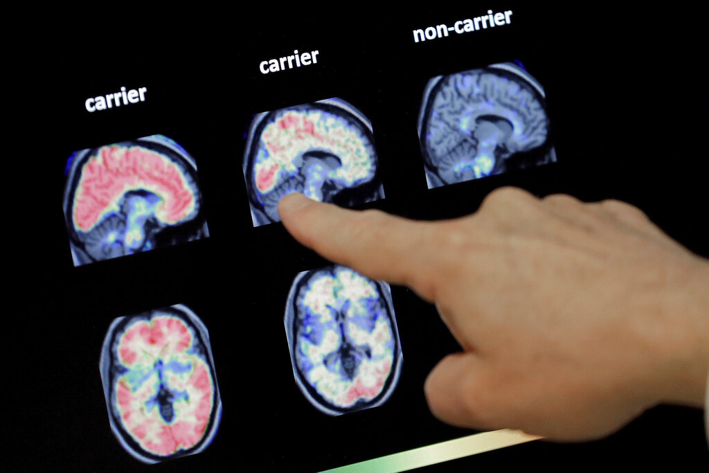 OPINION | CARL V. HILL: What looks like aging in loved ones could be Alzheimer’s