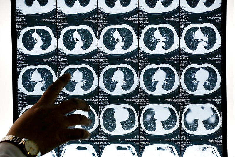 A doctor looks at a CT scan of a lung cancer patient at the Jingdong Zhongmei private hospital in Yanjiao, China's Hebei Province, in this Dec. 8, 2016 file photo. Medical professionals often use iodine-based contrast dye to generate internal images of the body, mostly via CT scans. (AP/Andy Wong)