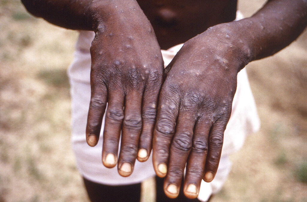 U.N. health agency declares monkeypox a global emergency - Vimarsana News