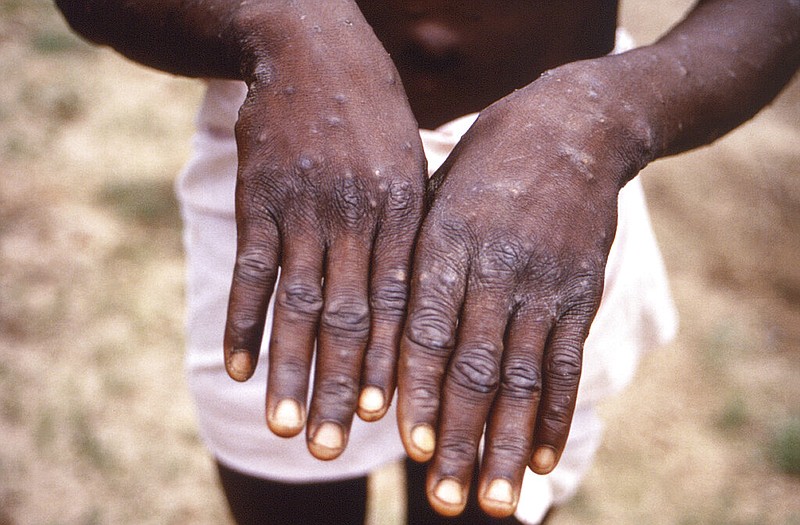 FILE - This 1997 image provided by the CDC during an investigation into an outbreak of monkeypox, which took place in the Democratic Republic of the Congo (DRC), formerly Zaire, and depicts the dorsal surfaces of the hands of a monkeypox case patient, who was displaying the appearance of the characteristic rash during its recuperative stage.(CDC via AP, File)