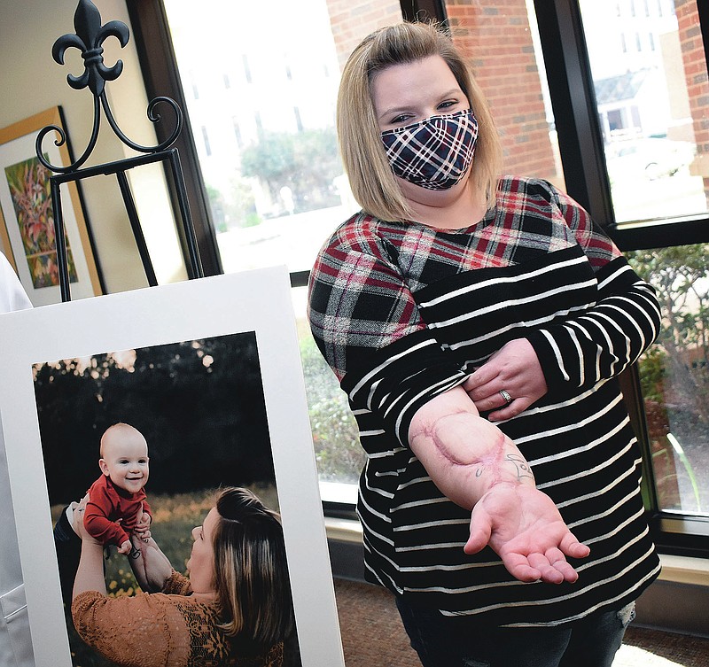 Shelbi Poe, 26, shows her arm after it was severed in a side-by-side accident, Thursday, Nov. 19, 2020  in Leesville, La.. Given her age and that she was the mother of twin infants, doctors at the Rapides Regional Medical Center Trauma Center in Alexandria, La.,, opted to reattach her arm instead of amputate. (Melinda Martinez/The Daily Town Talk via AP)