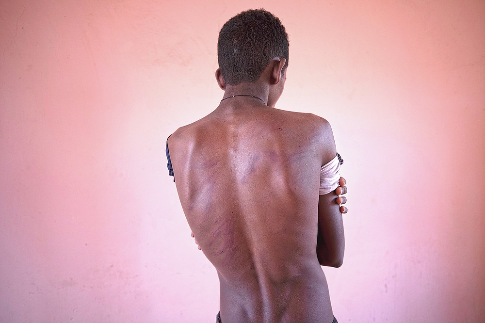 Fisseha Welay, an 18-year-old Tigrayan student who fled the conflict in Ethiopia's Tigray, shows the wounds on his back from being beaten by Eritrean soldiers, hours after his arrival to Hamdayet, eastern Sudan, near the border with Ethiopia, on March 17, 2021. The atrocities have been seared into the skin. They arrive in heat that soars above 100 degrees, carrying the pain of gunshot wounds, torn vaginas, fresh welts on malnourished backs from beatings. Unseen are the horrors that jolt them awake at night. Bodies strewn on riverbanks. (AP Photo/Nariman El-Mofty)