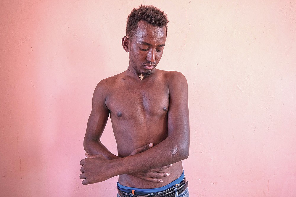Berhane Gebrewahid, a 24-year-old Tigrayan farmer who fled the conflict in Ethiopia's Tigray, stands for a portrait in eastern Sudan, near the border with Ethiopia, on March 14, 2021, showing his gunshot wound from Amhara and Wolkait fighters seeking his cattle. Gebrewahid said he saw food aid being distributed in February 2021 by Amhara authorities. But it was refused to Tigrayans. "I saw this," he said. "It happened to me. First, they asked your ethnicity." Even the name of his homeland had changed, he said. "They called it Northern Gondar," after a major city in Amhara. (AP Photo/Nariman El-Mofty)
