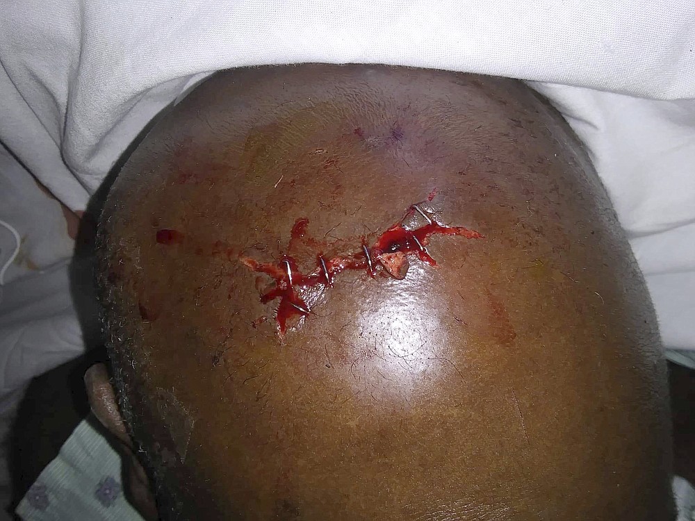 This May 30, 2019 photo provided by his attorneys shows a stitched wound on Aaron Bowman's head at the St. Francis Medical Center in Monroe, La., after, according to court documents, a police officer pummeled Bowman with a flashlight specially designed for shattering car glass, striking him 18 times as he was being handcuffed and not resisting. “I thought I was going to die that night — I bled so much,” Bowman says. “It’s hard to deal with. I can’t function half of the time. It’s just hard for me to think now.” (AP Photo)