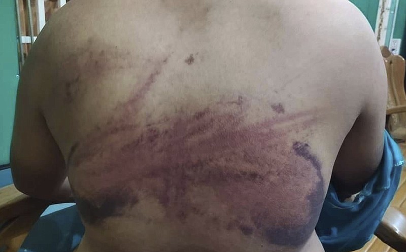 FILE - This photo obtained by The Associated Press shows injuries a man in his 20s says he received while being tortured by Myanmar's military during an interrogation session in March 2021. He says he was one of six youths who were arrested while sitting at a restaurant one evening. All of them were allegedly beaten during their arrest and questioning. They were released the next day. The U.S. State Department expressed outrage and demanded an investigation on Friday, Oct. 29, after The Associated Press reported that Myanmar&#x2019;s military has been torturing detainees in a systemic way across the country. (AP Photo, File)