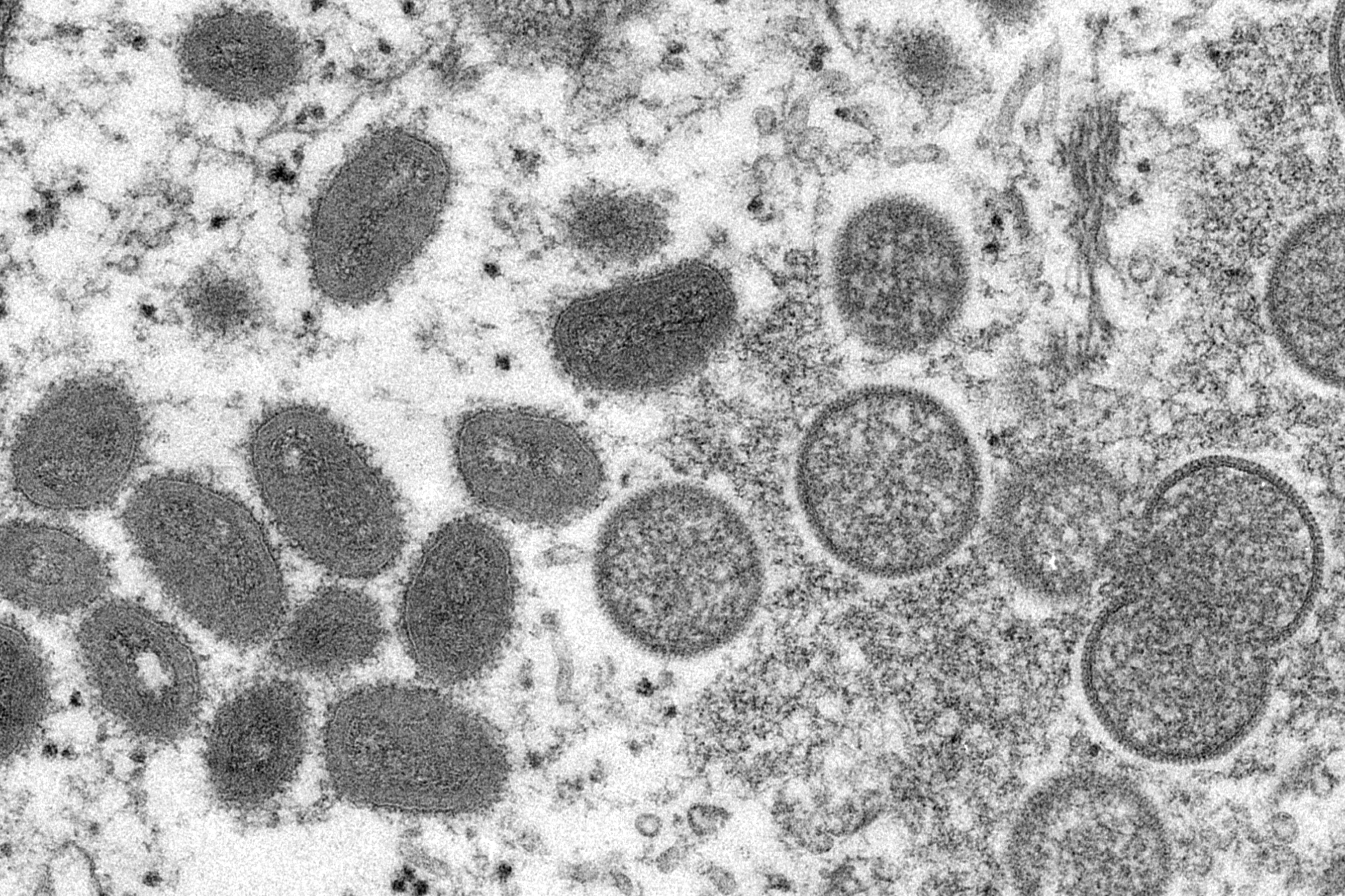 Monkeypox ID'd at LR high school - Vimarsana News