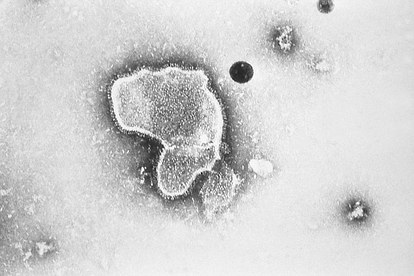 Respiratory virus drug for babies gets EU nod - Vimarsana News
