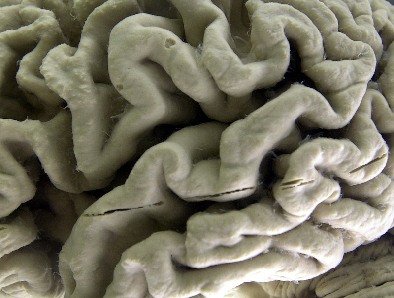 This Oct. 7, 2003, file photo shows a closeup of a human brain affected by Alzheimer's disease on display at the Museum of Neuroanatomy at the University at Buffalo in Buffalo, N.Y. An experimental Alzheimer’s drug modestly slowed the brain disease’s inevitable worsening, researchers reported Tuesday, Nov. 29, 2022. The next question is how much difference that might make in people’s lives. Japanese drugmaker Eisai and its U.S. partner Biogen had announced earlier this fall that the drug lecanemab appeared to work, a badly needed bright spot after repeated disappointments in the quest for better Alzheimer’s treatments. (AP Photo/David Duprey)