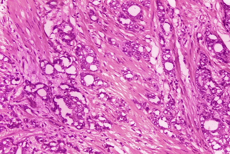 FILE - This 1974 microscope image made available by the Centers for Disease Control and Prevention shows changes in cells indicative of adenocarcinoma of the prostate. A study published by the New England Journal of Medicine on Saturday, March 11, 2023, finds long-term evidence that actively monitoring prostate cancer can be a safe alternative to immediate surgery or radiation. (Dr. Edwin P. Ewing, Jr./CDC via AP)