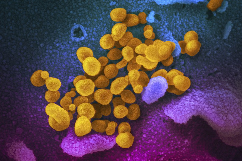 This undated, colorized electron microscope image made available by the U.S. National Institutes of Health in February 2020 shows the Novel Coronavirus SARS-CoV-2, indicated in yellow, emerging from the surface of cells, indicated in blue/pink, cultured in a laboratory. The sample was isolated from a patient in the U.S. Theres less risk of getting long COVID in the omicron era than in the pandemics earlier waves, according to a study of nearly 10,000 Americans that aims to help scientists better understand the mysterious condition, published in JAMA on Thursday, May 25, 2023. (NIAID-RML via AP, File)