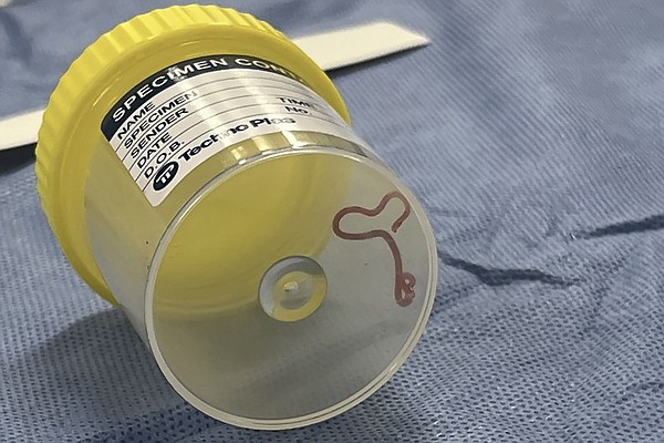Neurosurgeon plucks worm from Australian woman's brain - Vimarsana News
