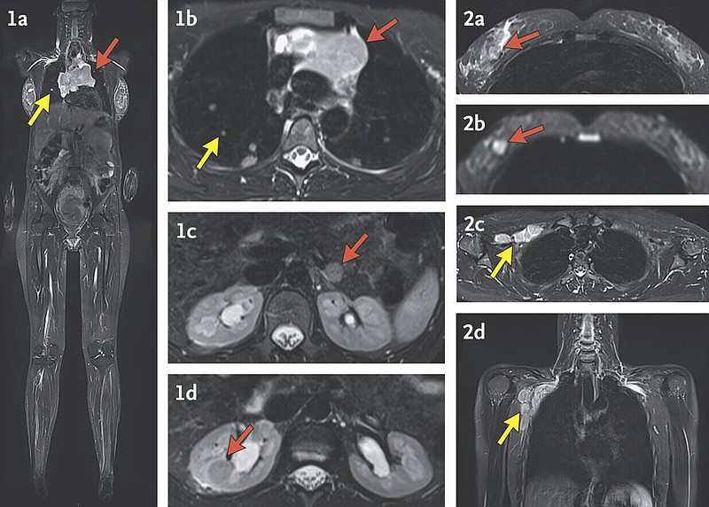 These MRI images with arrows indicating cancer were made during a study by researchers at the National Institutes of Health and published Wednesday, Dec. 4, 2024, in the New England Journal of Medicine. (The New England Journal of Medicine via AP)