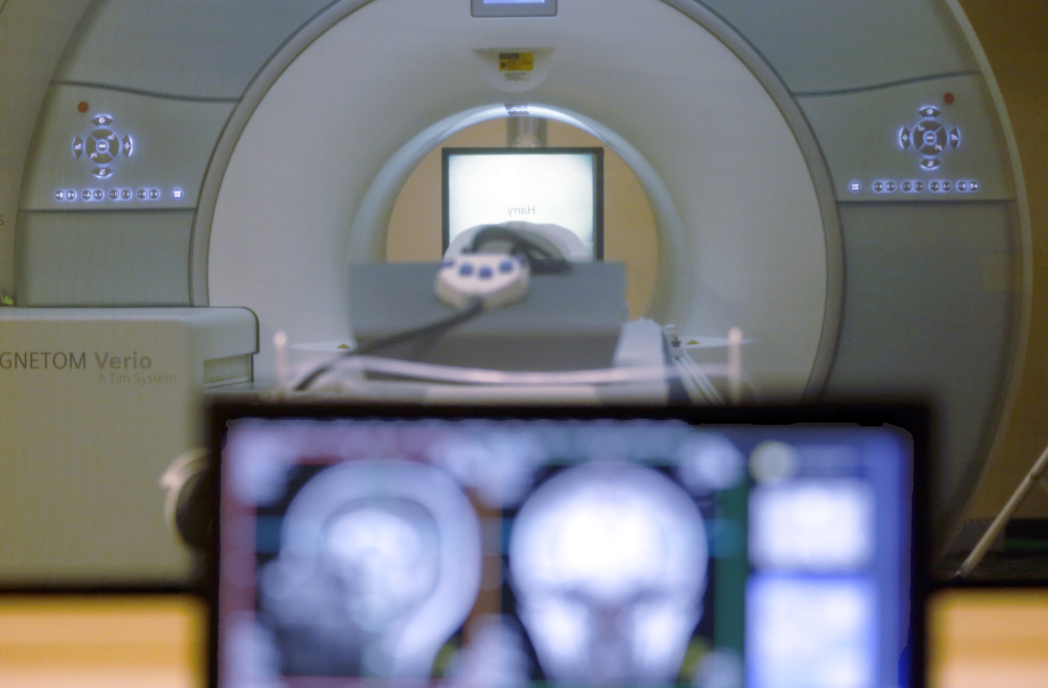 Kids with ADHD have some smaller brain regions than normal